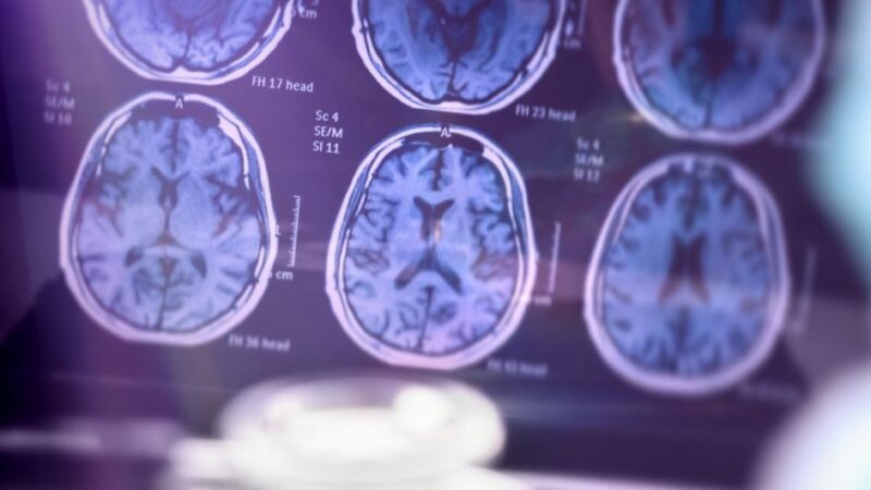 Alzheimer: especialista alerta para sintomas, fatores de risco e formas de retardar o avanço da doença